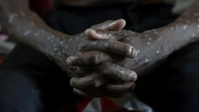 Mpox Naik di Thailand, Kenapa Bali Perlu Waspada?